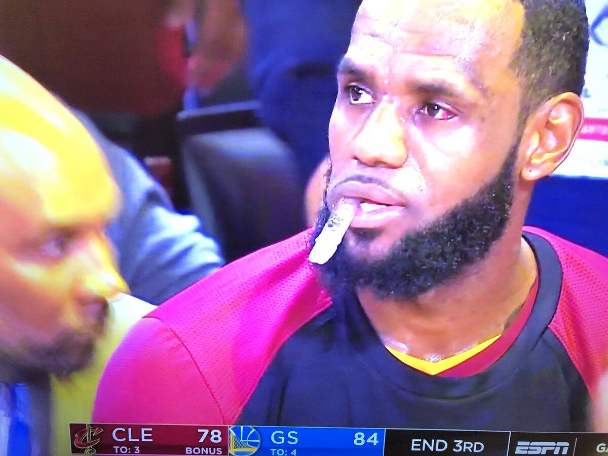 记者发图:詹姆斯左眼出现淤血